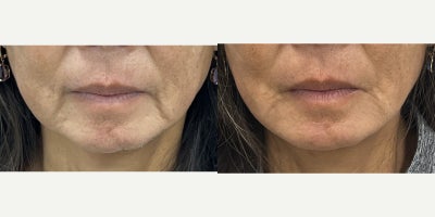 Dermal Fillers before and after photo