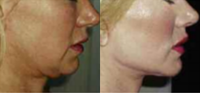Lip Fillers before and after photo
