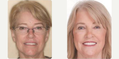 Teeth Whitening before and after photo