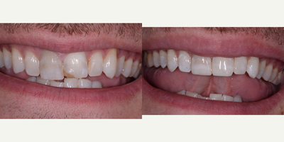 Dental Bonding before and after photo
