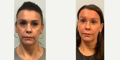 Nonsurgical Facelift before and after photo