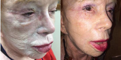 Radiesse before and after photo