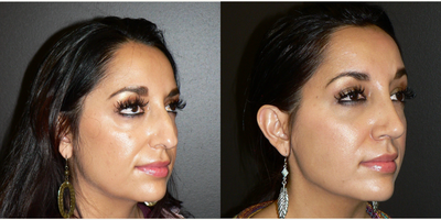 Rhinoplasty before and after photo