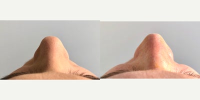Rhinoplasty before and after photo