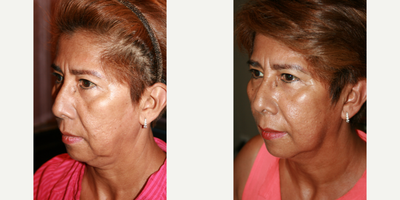 Thread Lift before and after photo