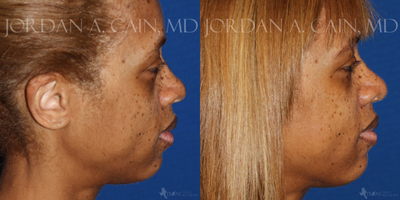 African American Rhinoplasty before and after photo