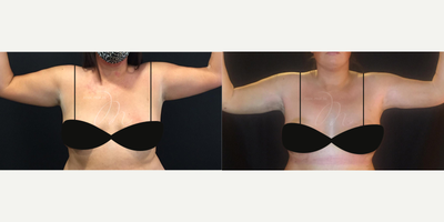 Arm Lift before and after photo