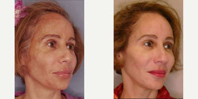 Chemical Peel before and after photo