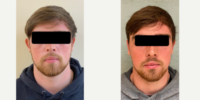 Ear Surgery before and after photo