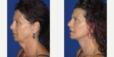 Facelift before and after photo
