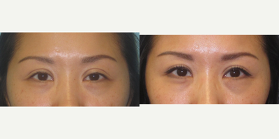 Ptosis Surgery before and after photo