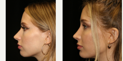 Rhinoplasty before and after photo