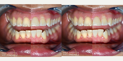 Teeth Whitening before and after photo