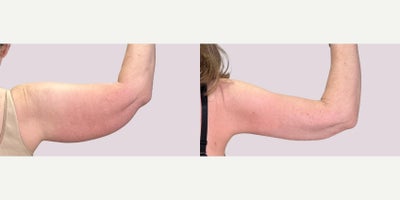 Arm Lift before and after photo