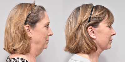 Chin Liposuction before and after photo