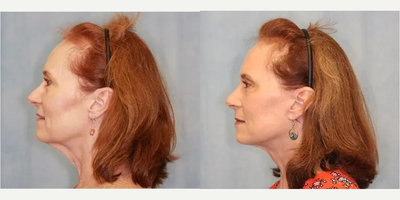 Facelift before and after photo