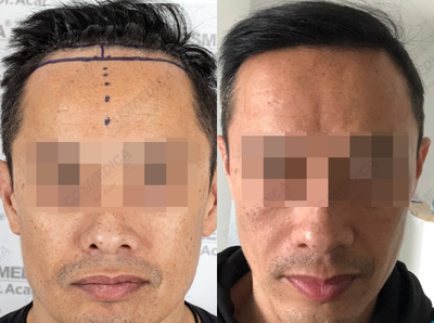 Hair Transplant before and after photo