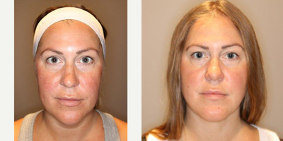 Laser Liposuction before and after photo