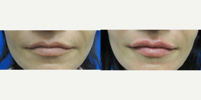 Lip Fillers before and after photo