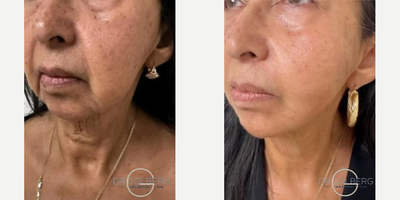 Nonsurgical Facelift before and after photo
