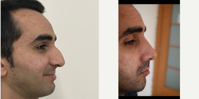 Rhinoplasty before and after photo