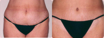 Tummy Tuck before and after photo