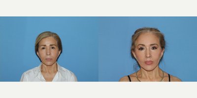 Brow Lift before and after photo