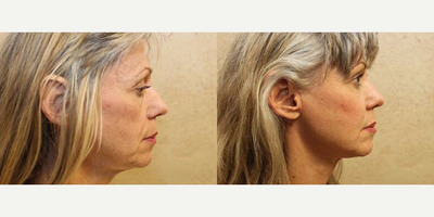 Facelift before and after photo
