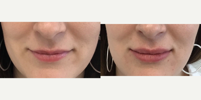Juvederm before and after photo