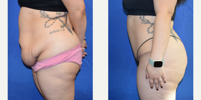 Tummy Tuck before and after photo