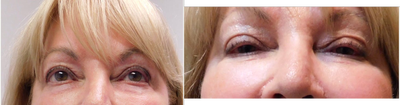 Voluma before and after photo