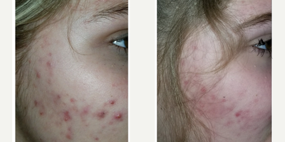 Accutane before and after photo