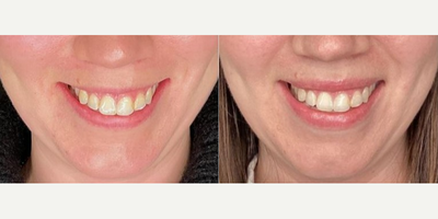 Botox for Gummy Smile before and after photo