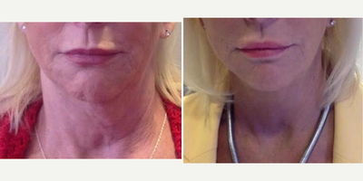 Kybella before and after photo