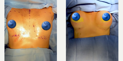 Breast Implants before and after photo