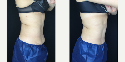 CoolSculpting before and after photo
