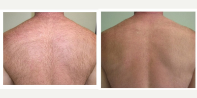 Laser Hair Removal before and after photo