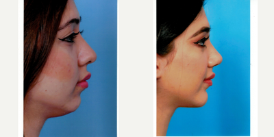 Chin Implant before and after photo