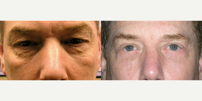Eyelid Surgery before and after photo