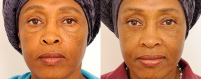 Eyelid Surgery before and after photo