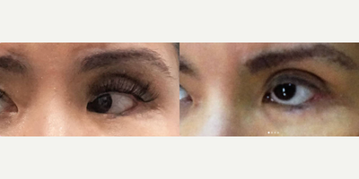 Eyelid Surgery before and after photo