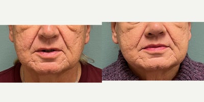 Lip Lift before and after photo