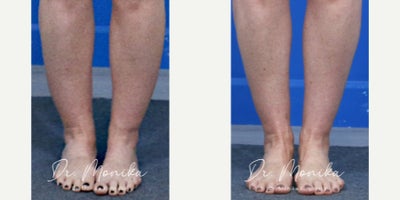 Liposuction before and after photo