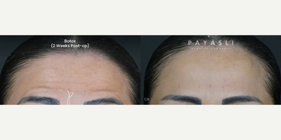 Botox before and after photo