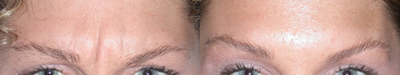 Botox before and after photo
