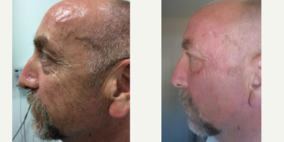 CO2 Laser before and after photo