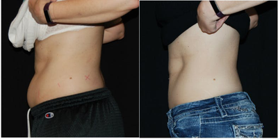 CoolSculpting before and after photo