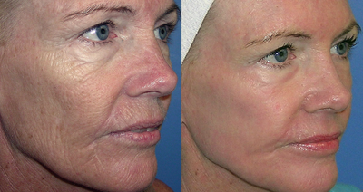 Laser Resurfacing before and after photo
