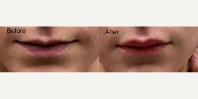 Dermal Fillers before and after photo