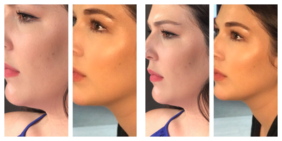 Kybella before and after photo